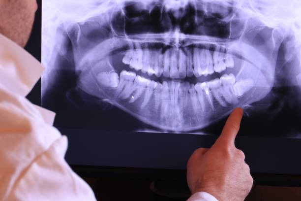 Best Knocked-Out Tooth (Avulsed Tooth) Treatment in Wolfforth, TX